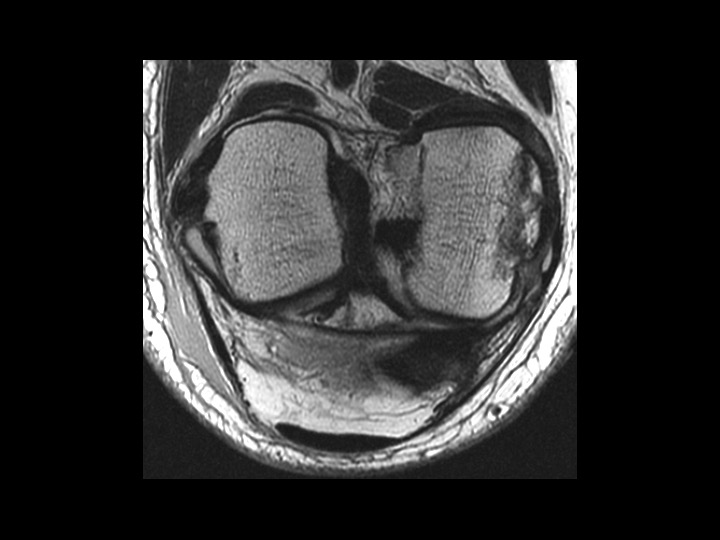 Figure 4 for case avulsion fracture ( RID4653 )